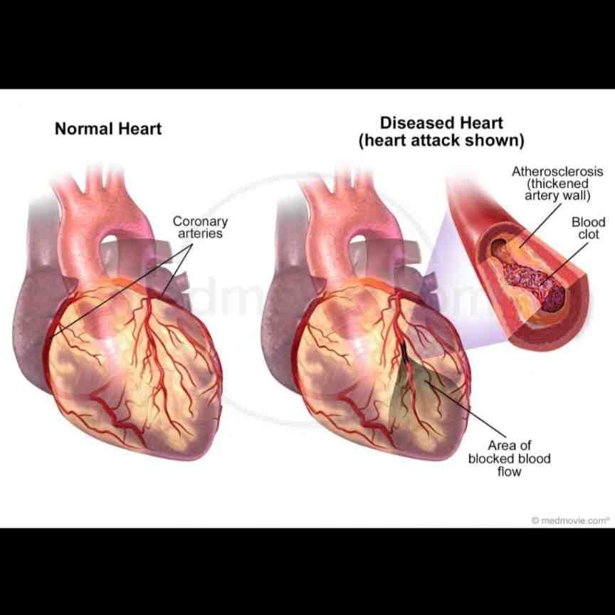 Heart Disease: What You Should Know to Protect Your Heart 